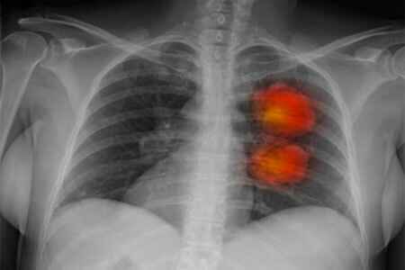 Akciğer kanseri: semptom ve bulgular, derecesi, tedavisi ve prognozu