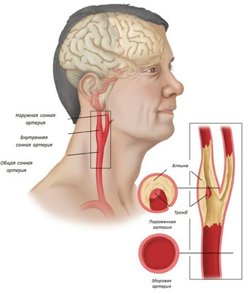 Nestenotická ateroskleróza BCA (brachiocefalické artérie)