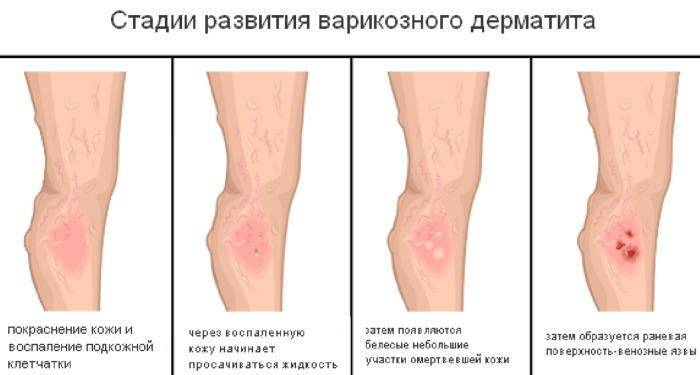 Bacaklarda dermatit. Bir çocuk, bir yetişkin için tedavi, merhemler ve kremler