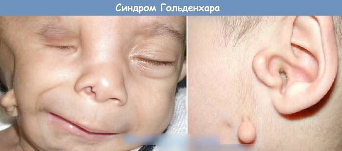 Puntea largă a nasului la un copil. Ce este, motive