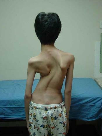 Scoliosis of the 4th degree