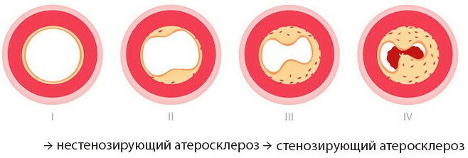 Nestenotická ateroskleróza BCA (brachiocefalické tepny)