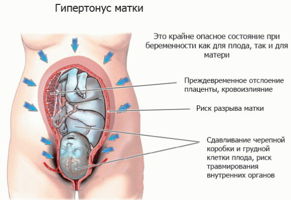 Hypertonicity of the uterus during pregnancy 1-2-3 trimester. Treatment