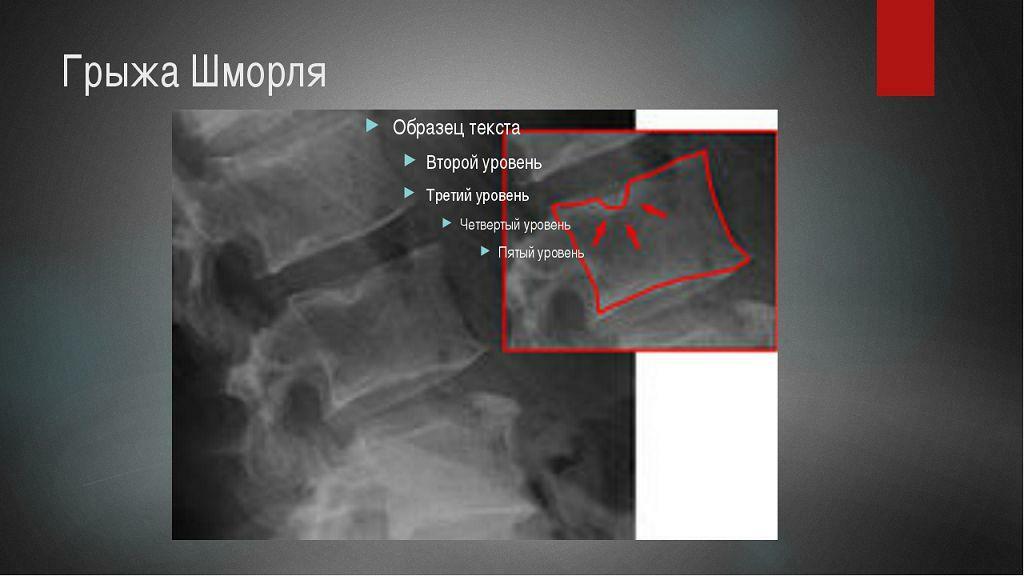 Hernias schmorl a coloanei vertebrale toracice: tratament - mai multe informații