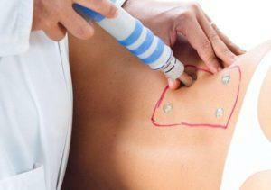 Injection of drugs into trigger points