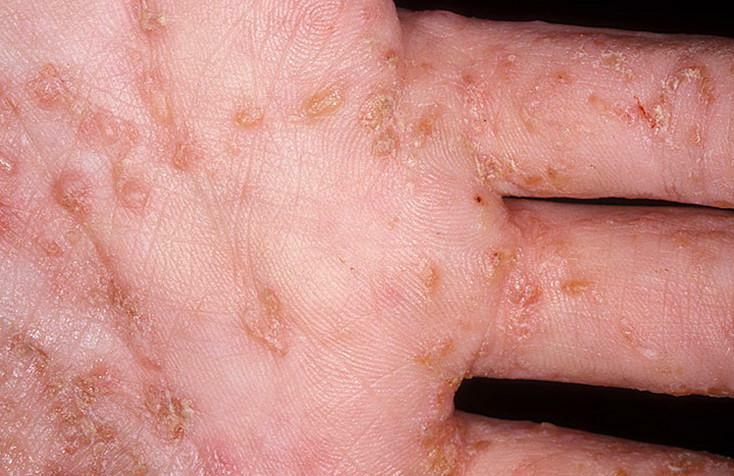 Symptoms and photos of scabies