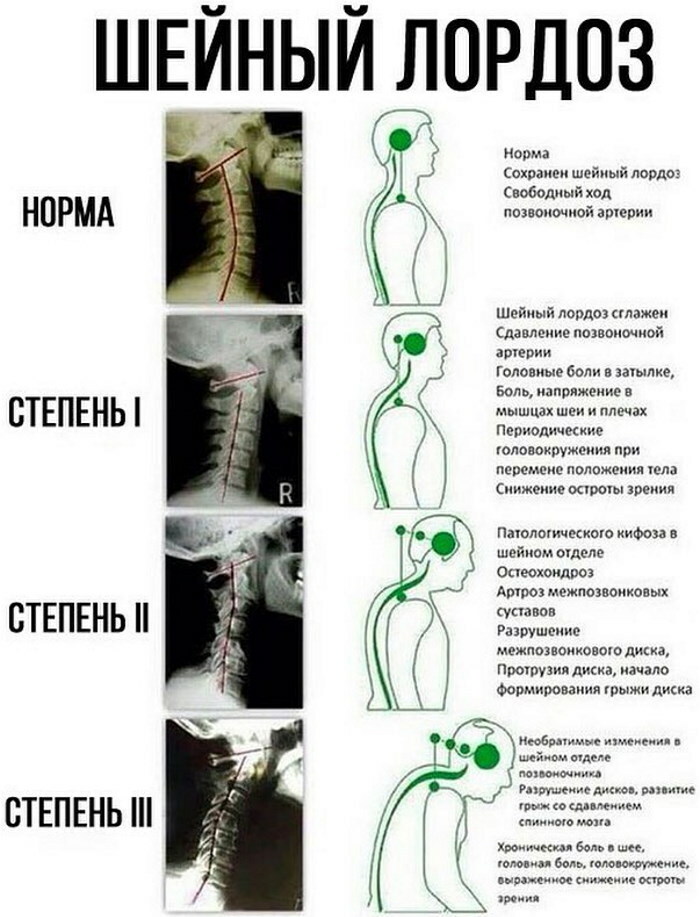 Lordosis and kyphosis of the spine. What is it, photo, treatment, exercises