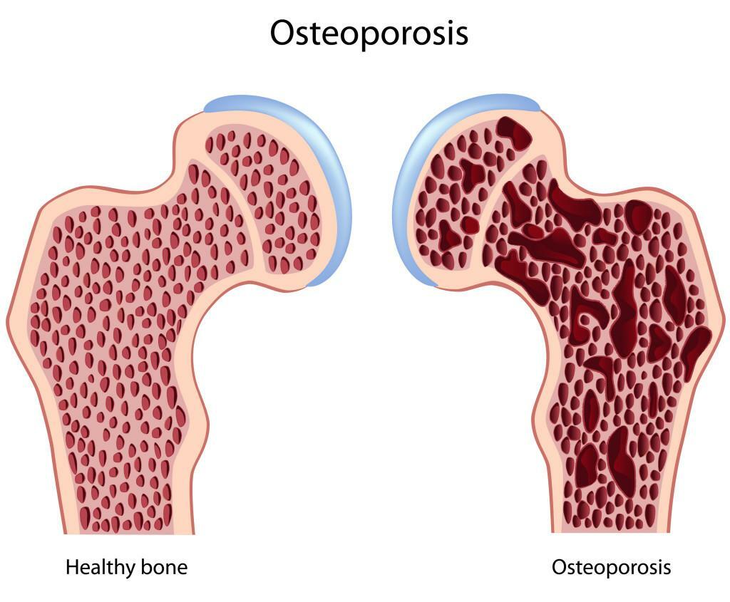 Liečba osteoporózy u žien, prevencia, výživa, cvičenie, med.preparaty!