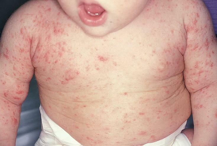 Scabies in the child - photo
