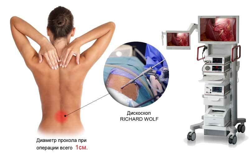 Lomber omuriliğin fıtığını çıkarmak için operasyon - her türlü operasyonun ayrıntılı bir tarifi