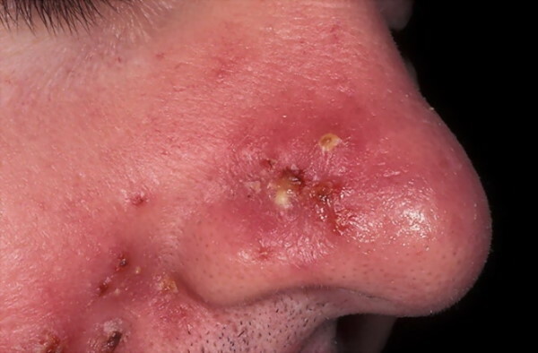 Sifilis pe față. Foto de erupții cutanate, cum arată