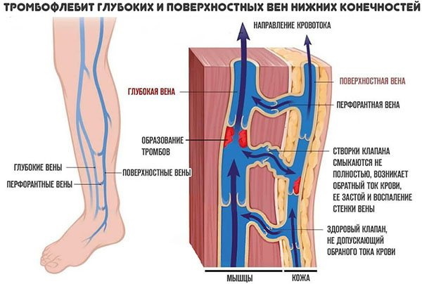 Alt ekstremitelerin perforan damarları. Bu nedir, anatomi