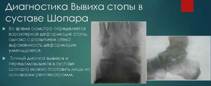 Chopard e Lisfranc congiunto. Anatomia, radiografie, legamenti, lussazione del piede, artrosi