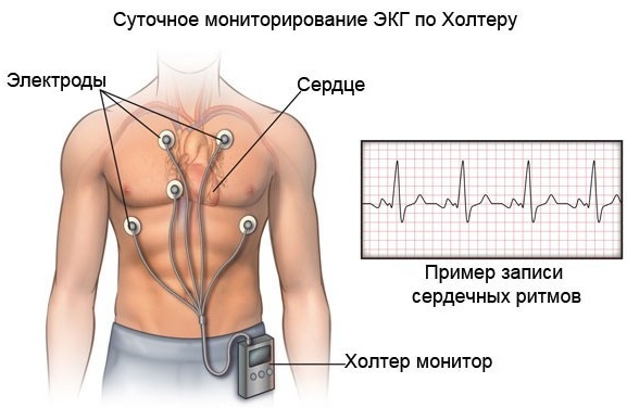 Komorový extrasystol na EKG: příznaky, dekódování