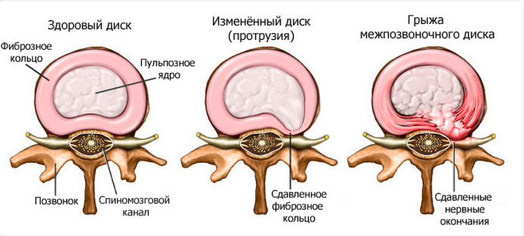 Formación de un disco intervertebral herniado