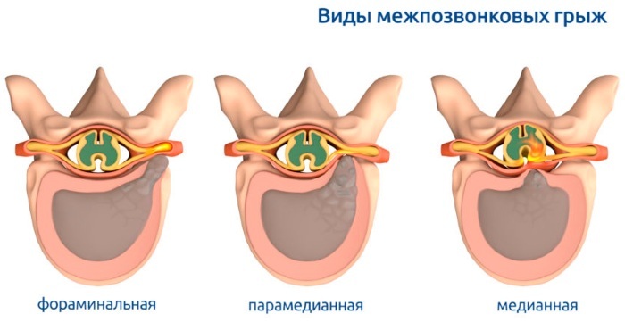 L5-S1 hernia. Where is the person, photo, spine diagram, protrusion