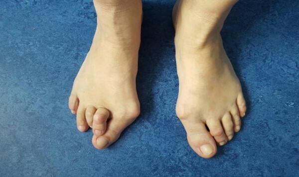 Gout on the legs. Photo, treatment, pills, alternative methods