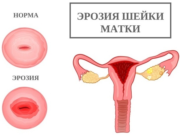 Spumă în urină la femei. Cauze și tratament la domiciliu