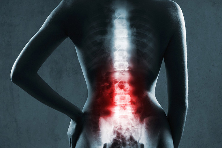 Tubercolosi spinale: descrizione, cause, sintomi