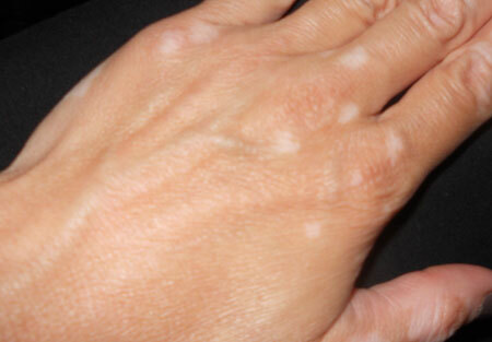 Vitiligo - how to treat white spots on the skin?