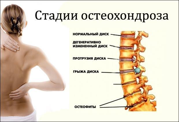 Etapas de la osteocondrosis de la columna vertebral