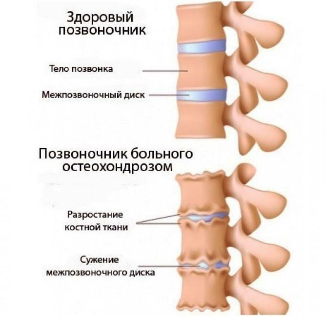 La columna vertebral con osteocondrosis