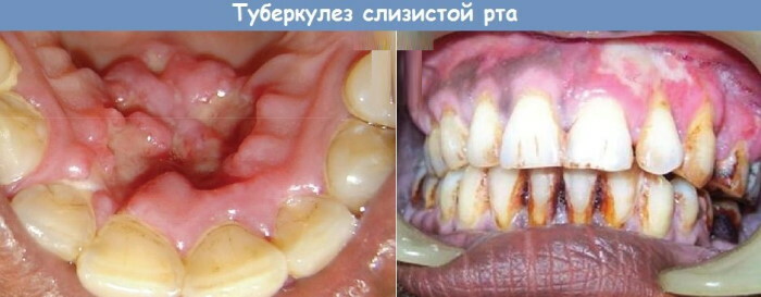 Maladies de la cavité buccale et des dents. Photos, causes et traitement