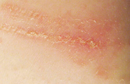 Dermatitis de contacto: síntomas y tratamiento, fotografía, prevención