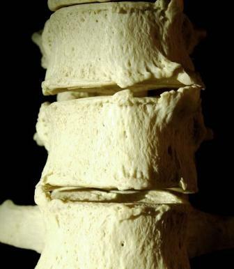 Osteophyten( benige stekels) van de wervelkolom