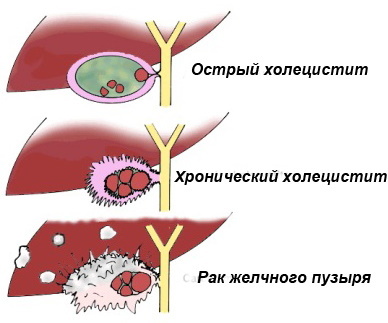 Enfermedades del hígado y la vesícula biliar. Síntomas, tratamiento