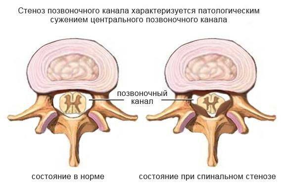 Stenosis of the spinal canal