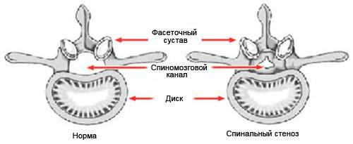 Spinal stenozlu sağlıklı disk ve disk