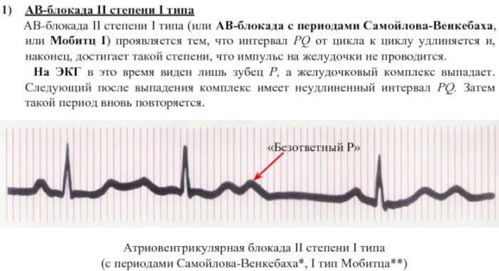 Frederick's syndrome on the ECG. Signs of what it is, reasons