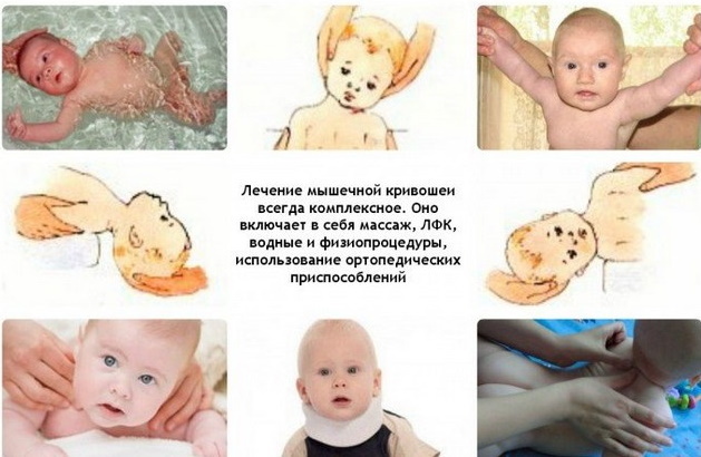 Kręcz szyi u niemowląt 2-3-4-6 miesięcy. Objawy, zdjęcia, leczenie