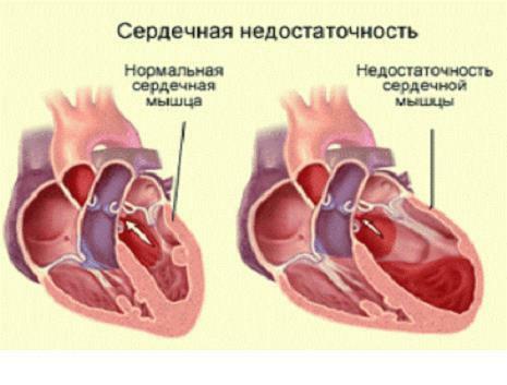 Insuficiencia cardíaca