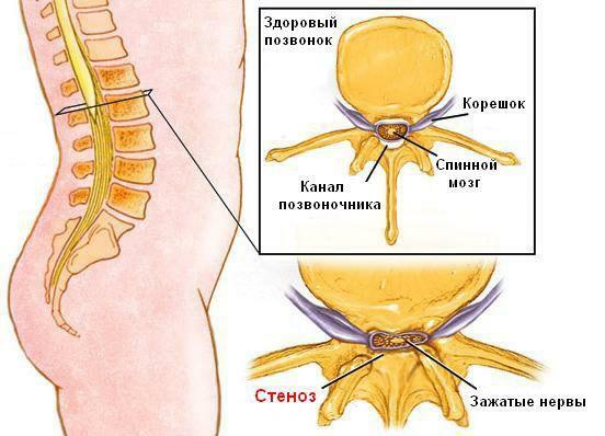 Estenosis del canal espinal