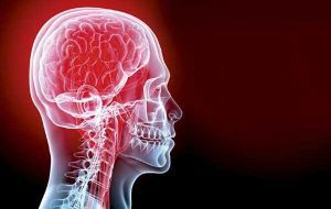 Simptomele și tratamentul diferitelor forme de sindrom de artera vertebrală