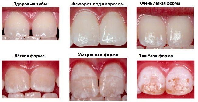 סולם צבעי השיניים ויטה. תמונות, גוונים לפי מספרים
