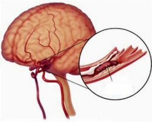 Angioencefalopatia jest niebezpieczną chorobą naczyniowo-mózgową
