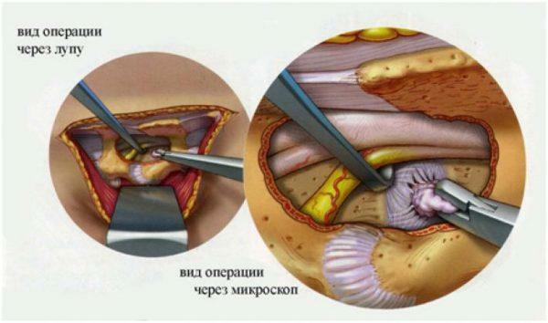Tratamiento de la hernia intervertebral lumbar