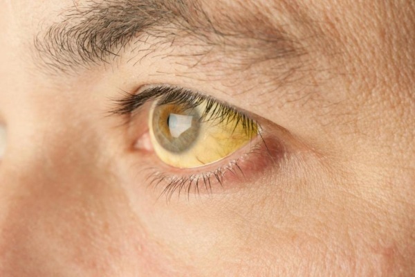 Jaundice in adults. Causes, symptoms, treatment, consequences