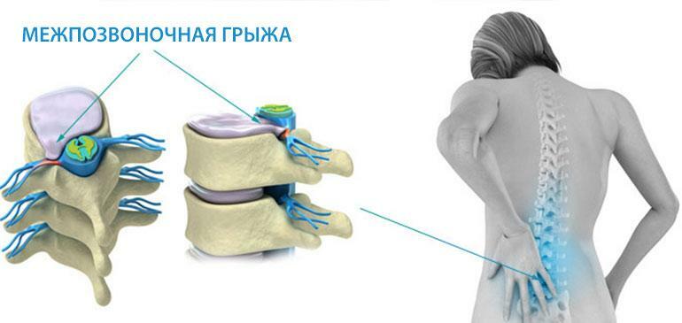 Operación para eliminar una hernia de la columna lumbar