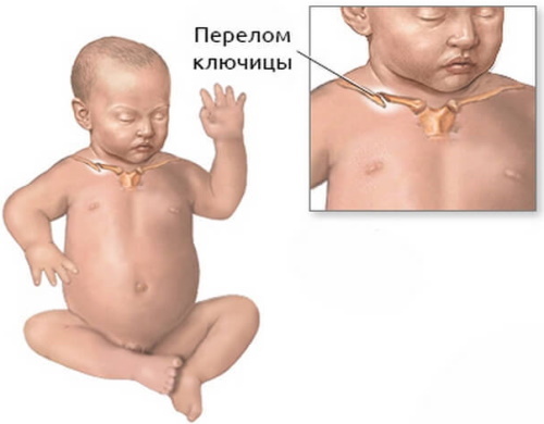 Fraktur av nyckelbenet hos ett 2-årigt barn utan förskjutning. Behandling