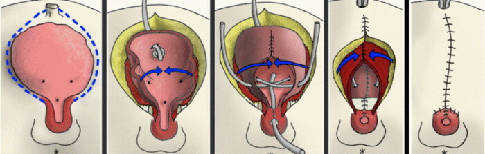 Volumul vezicii urinare a unui bărbat, bărbați, femei. Normă