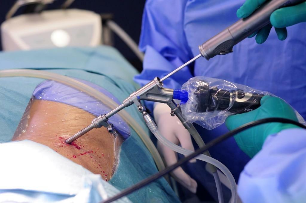 Endoscopic removal of a herniated spine