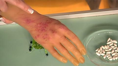 How to treat scabies