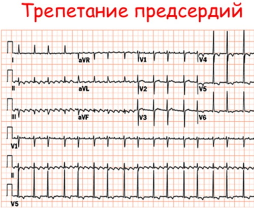 Pitvari remegés az EKG -n. Dekódolás, kezelés