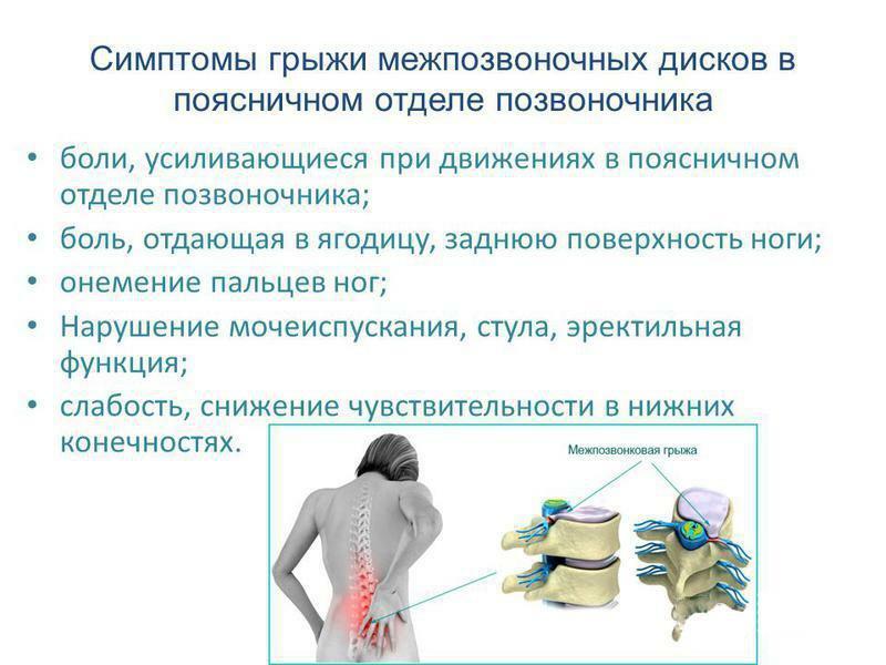 Simptomele unui disc intervertebral herniat la nivelul coloanei vertebrale lombare