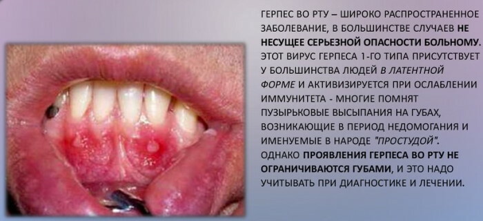 Maladies de la cavité buccale et des dents. Photos, causes et traitement