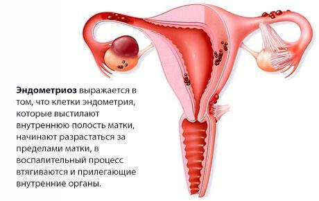 endometriyozis